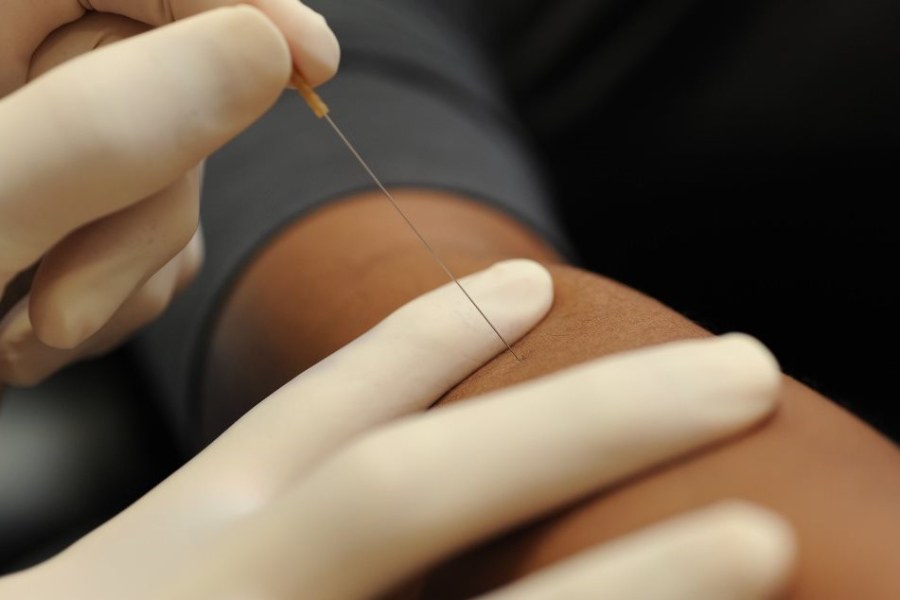 Physiotherapy and dry needling in Port Coquitlam